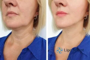 Double chin before and after Hi-Fu treatment 4 Book your double chin treatment Hucknall under Huthwaite today! We are here to help!