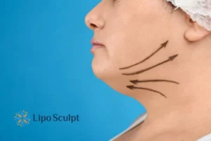 Double chin before and after Hi-Fu treatment 3 Boost your confidence with a Double chin treatment Hucknall under Huthwaite