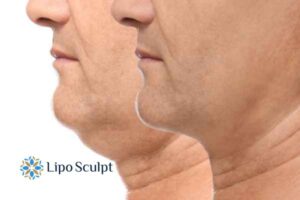 Double chin before and after Hi-Fu treatment 2 Double chin treatment Hucknall under Huthwaite from Lipo Sculpt - feel more confident today!
