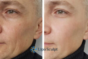 How to Fight Aging Symptoms 3 Fight Aging Symptoms Hucknall under Huthwaite With HIFU and Morpheus8 Today!