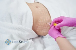 Are The Results From Aqualyx Permanent? 1 Do you want to know how long Aqualyx Hucknall under Huthwaite results last?