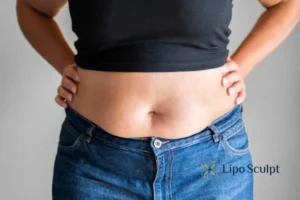 Bidding Farewell to Muffin Tops with Aqualyx Fat Injections 2 Do you wish you could reduce your muffin top Hucknall under Huthwaite With Aqualy fat dissolving injections you can!