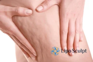 CoolSculpting for Legs: The Innovative Approach to Redefining Your Legs 5 Start your journey today book your coolsculpting treatment Hucknall under Huthwaite online today!