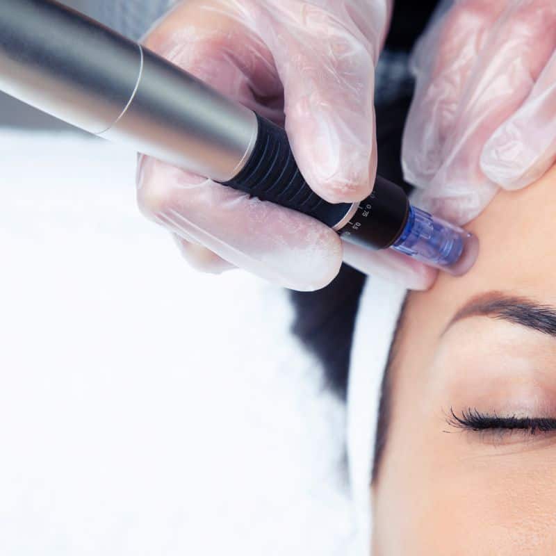 Morpheus8 treatment Hucknall under Huthwaite from Lipo Sculpt - Book in today!